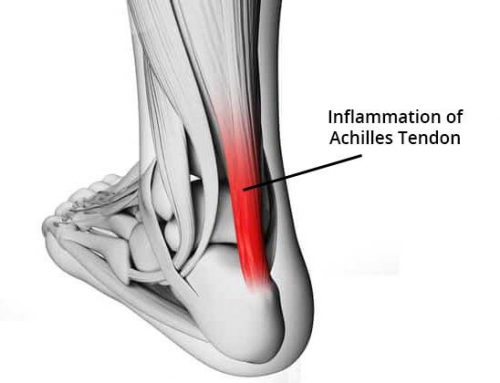 Achilles injuries and return to running