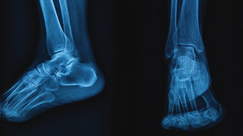 Stress Fractures in runners